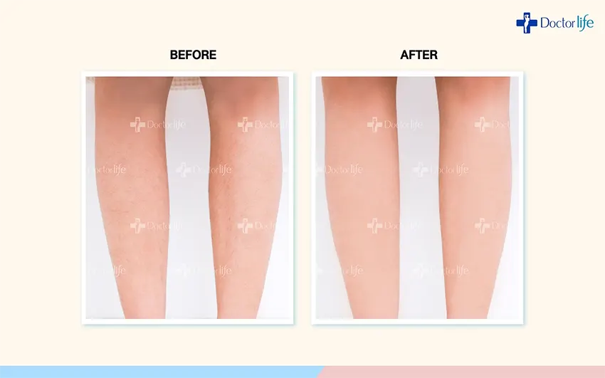 เลเซอร์กำจัดขา เรียวสวย ผิวเรียบเนียน และไร้ขน