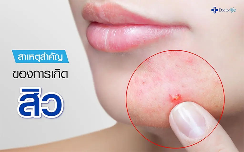 subcision รักษาสิว ผิวหน้าเนียนให้เนียนใส