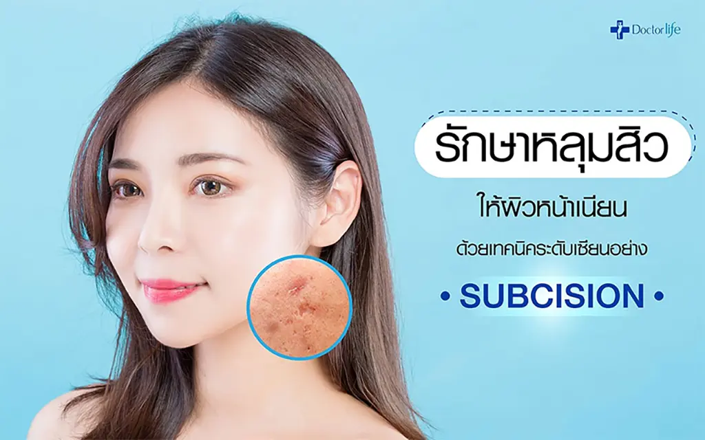 subcision รักษาสิว ผิวหน้าเนียนให้เนียนใส