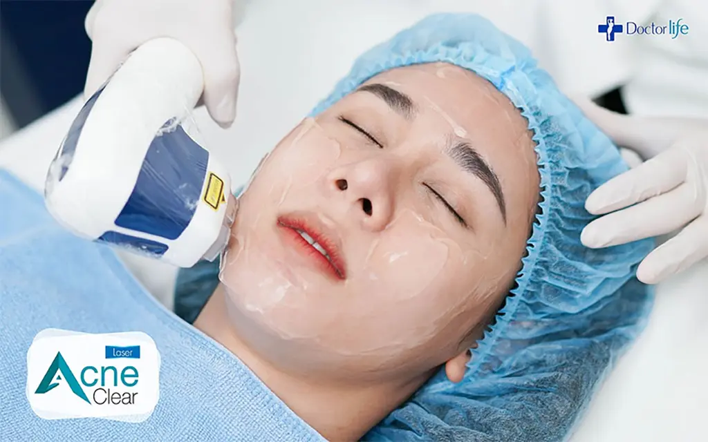 acne clear laser การรักษาสิวด้วยการเลเซอร์สิว
