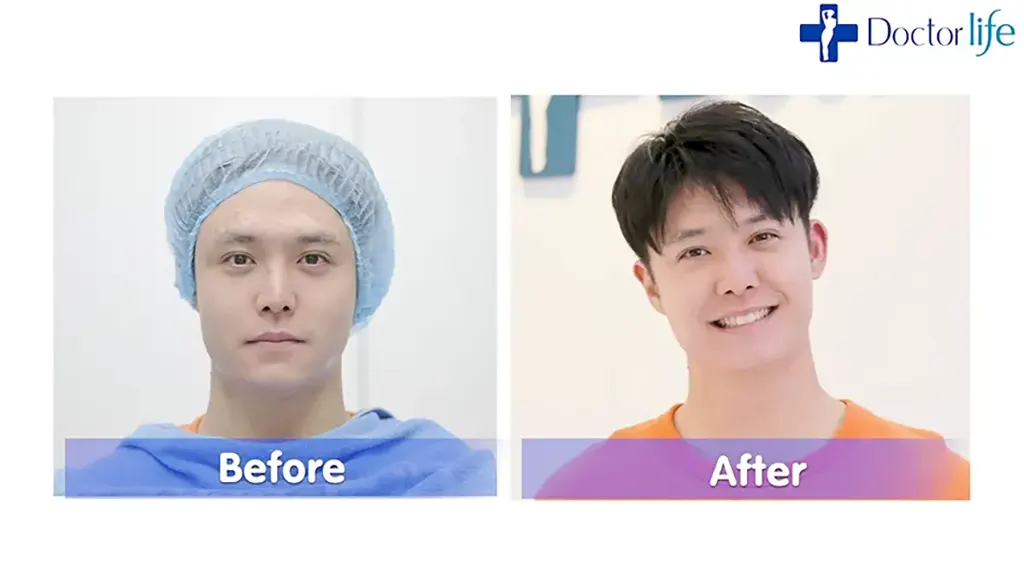 acne clear laser การรักษาสิวด้วยการเลเซอร์สิว