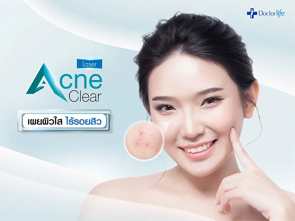 acne clear laser การรักษาสิวด้วยการเลเซอร์สิว