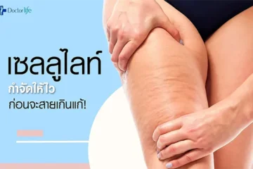 เซลลูไลท์ กำจัดให้ไวก่อนจะสายเกินแก้
