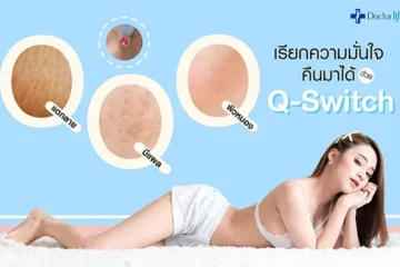 เลเซอร์ q switch ลบผิวหมองคล้ำ