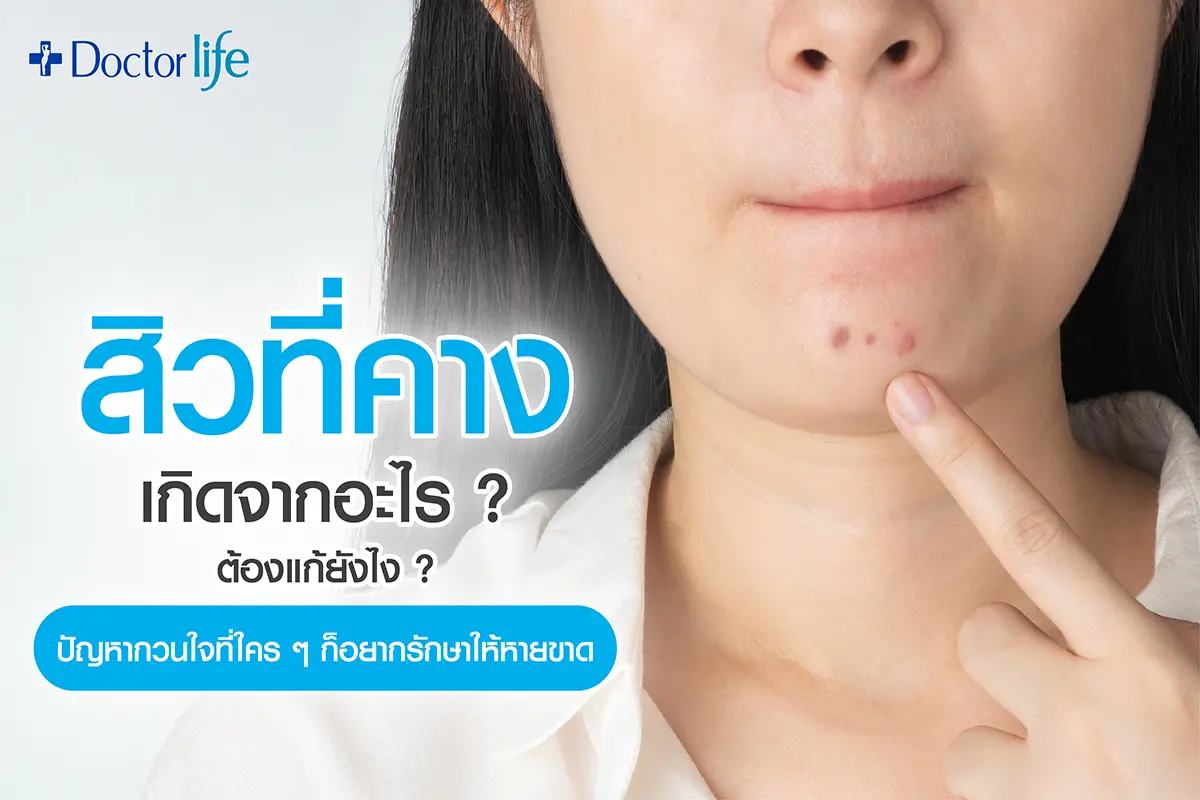 สิวที่คาง เกิดจากอะไร ต้องแก้ยังไง