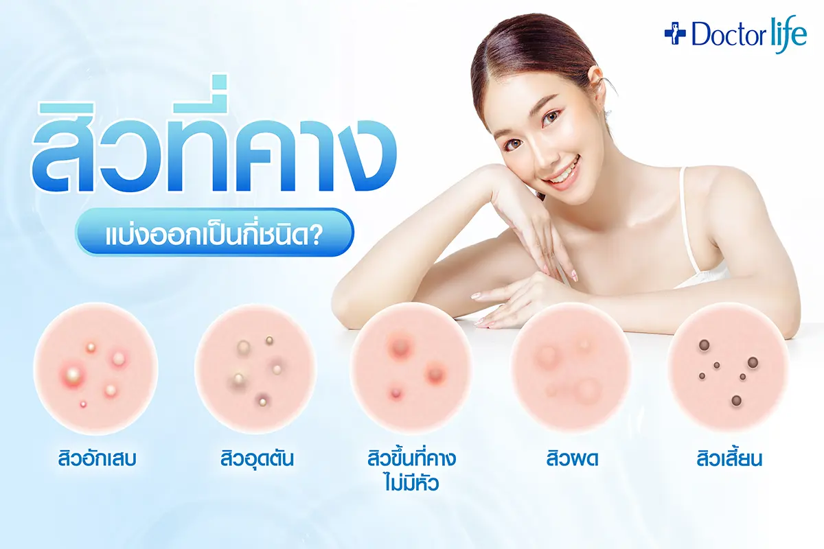 ประเภทของสิวที่คาง แบ่งออกเป็นกี่ชนิด