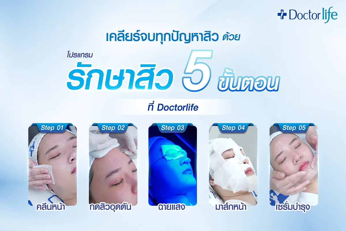 เคลียร์จบทุกปัญหาสิว ด้วยโปรแกรม Acne Clear รักษาสิว 5 ขั้นตอน