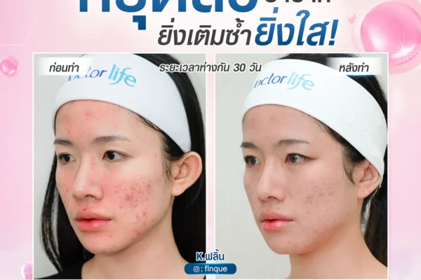 16 07 67 exo skin หยุดสิว b a (2) (1)