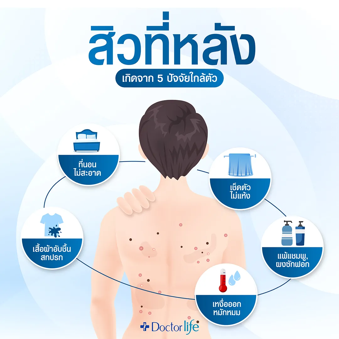 สิวที่หลังเกิดจาก 5 ปัจจัยใกล้ตัว