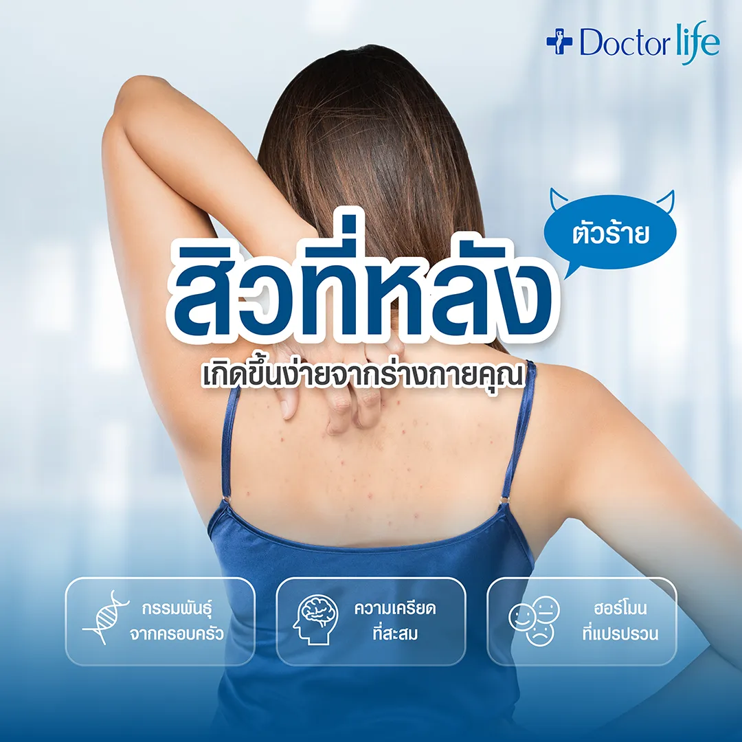 สิวที่หลัง เกิดขึ้นง่ายจากร่างกาย